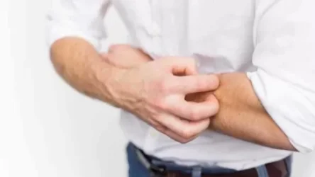 Ինչպե՞ս վերացնել  միջատների խայթոցից առաջացած քորը` պարզ ժողովրդական միջոցներով