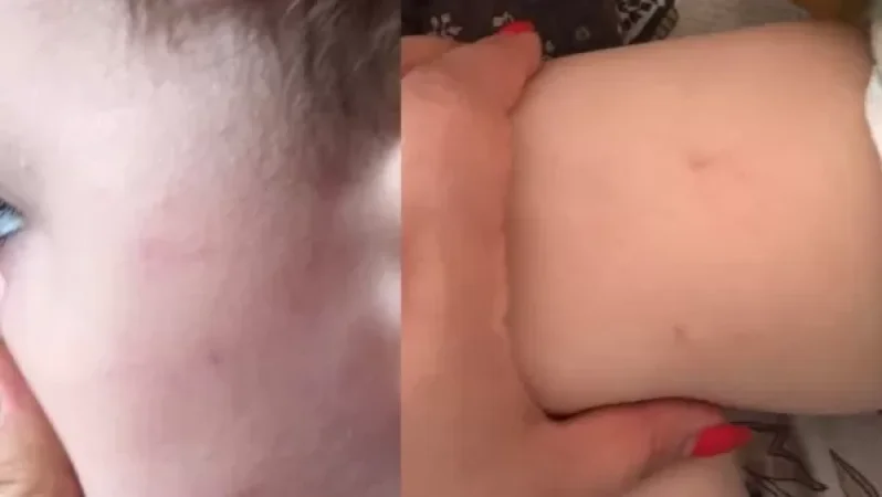 Երևանում երեխան մանկապարտեզից տուն է եկել կապտուկներով