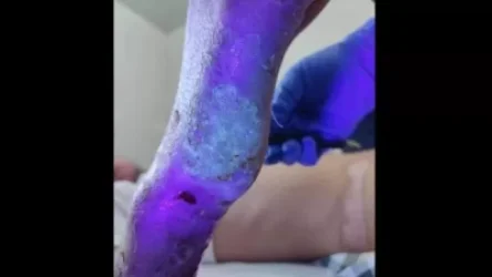 Այս պահին դեռ 8 զինծառայող ունենք, որոնք Ադրբեջանի կիրառված սպիտակ ֆոսֆորից ստացված ծանրագույն այրվածքներ ունեն