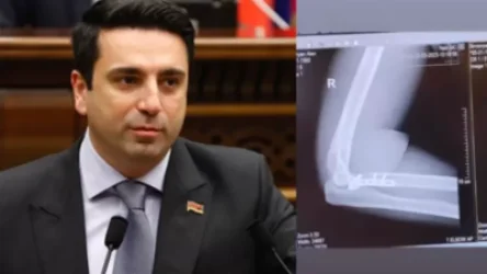 ԼՈՒՍԱՆԿԱՐ. Ալեն Սիմոնյանը հրապարակել է իր` վիրահատված արմունկի ռենտգեն պատկերը