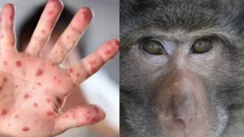 ԱՀԿ-ն կփոխի կապիկի ծաղիկի անունը ռասիստական կարծրատիպերի պատճառով