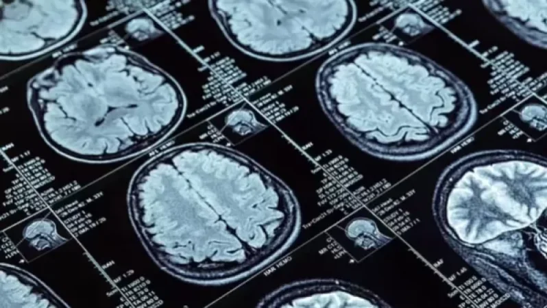 Շոտլանդացին ուղեղի ուռուցքի նոպայից հետո մոռացել է անգլերենն ու խոսել միայն ֆրանսերեն. Daily Mail