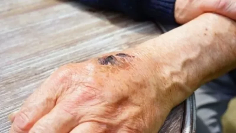 Սիբիրյան խոցով հիվանդանոց տեղափոխած բնակիչները անասուն մորթողներն ու դրանց միսը մշակողներն են եղել․ NEWS