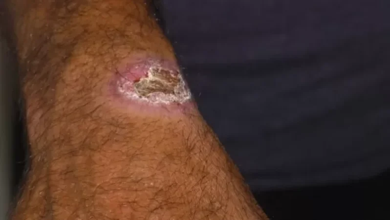 Սիբիրյան խոցով վարակված հիվանդների թիվը հասել է 10-ի. SHANTNEWS