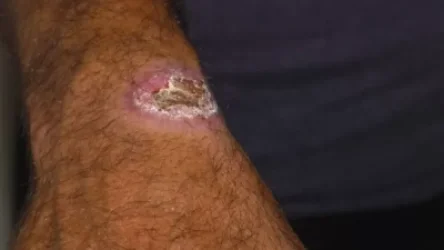 Սիբիրյան խոցով վարակված հիվանդների թիվը հասել է 10-ի. SHANTNEWS