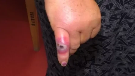 Շիրակի մարզի Իսահակյան գյուղում Սիբիրյան խոցով վարակված հիվանդների թիվը հասել է 10-ի