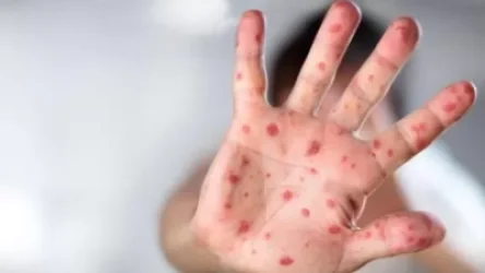 Կարմրուկը Հայաստան է «եկել» արտերկրից, թիրախում չպատվաստված անձինք են․ ԱՆ ներկայացուցիչ