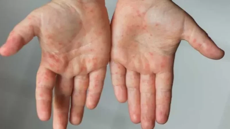 Կարմրուկի լաբորատոր հաստատված դեպքերի թիվը հասել է 43-ի