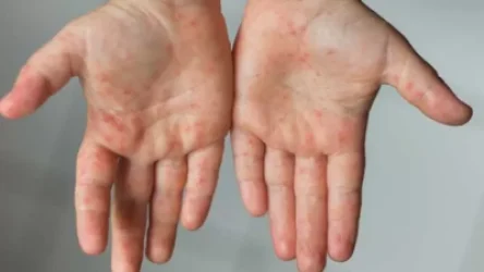 Կարմրուկի լաբորատոր հաստատված դեպքերի թիվը հասել է 43-ի