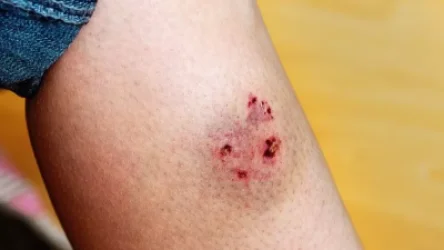 Զգուշացե՛ք «Կատաղություն» հիվանդությունից. ՀՎԿԱԿ-ը տեղեկացնում է