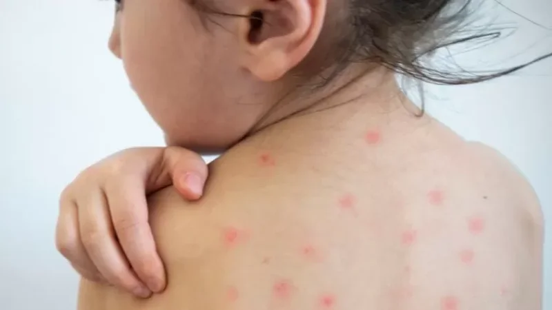 Կարմրուկը` Հայաստանում. կա՞ արդյոք նախադպրոցական և դպրոցական հաստատությունների փակման անհրաժեշտություն