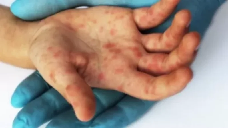 Անսովոր ցան՝ օմիկրոն շտամով վարակված երեխաների մոտ