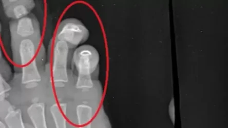 ՏԵՍԱՆՅՈՒԹ․  8 տարեկան երեխան փայտ է կտրել ու վնասել 2 տարեկան եղբոր մատները