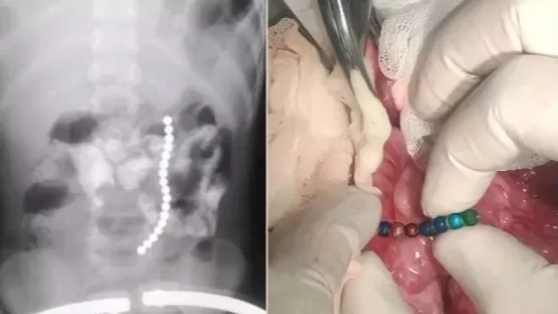 Երևանում 3 տարեկան երեխայի որովայնից 17 մագնիսե գնդիկ է հեռացվել