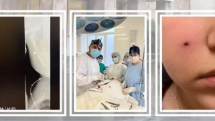 14-ամյա երեխայի այտի փափուկ հյուսվածքներում հայտնաբերվել է մետաղական գնդիկ