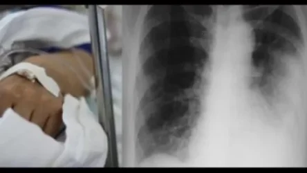 «Աստղիկ» ԲԿ-ում երկկողմանի թոքաբորբով Իրանի քաղաքացի է մահացել. Mamul.am