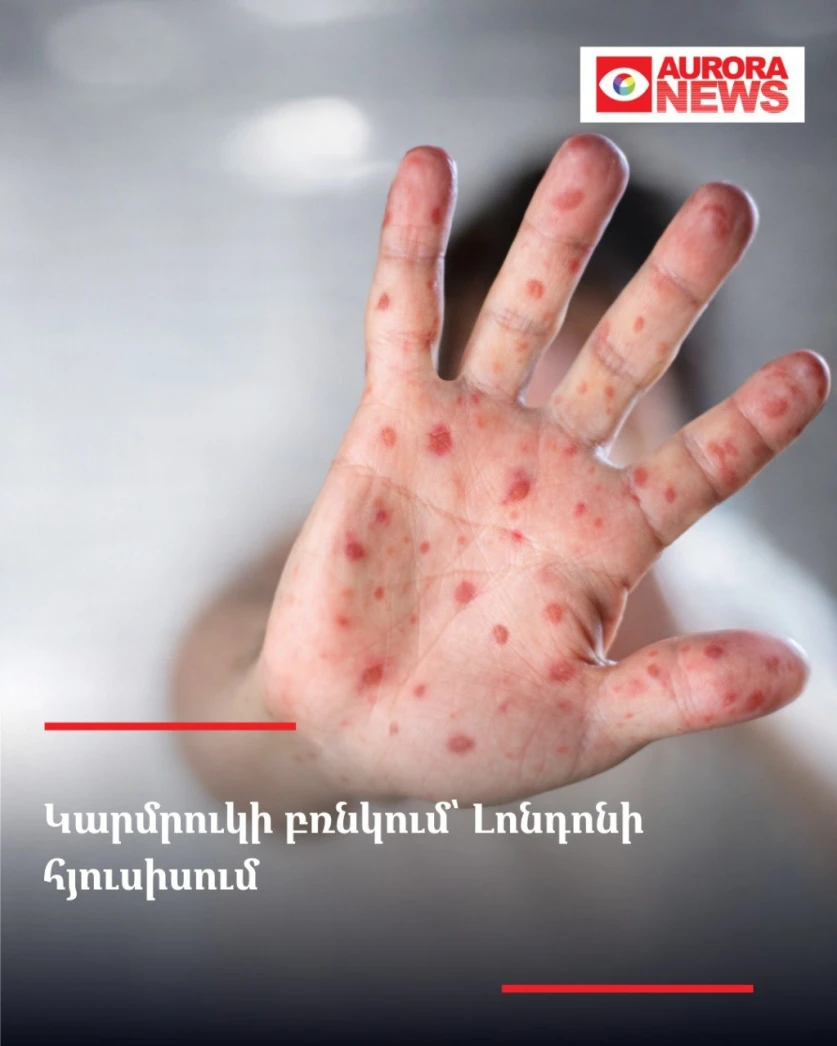 Կարմրուկի բռնկում՝ Լոնդոնի հյուսիսում