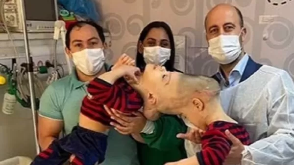 ԼՈՒՍԱՆԿԱՐՆԵՐ. 100 բժիշկ վիրահատել և հաջողությամբ բաժանել են միաձուլված գլուխներով երկվորյակներին. Բրազիլիա 