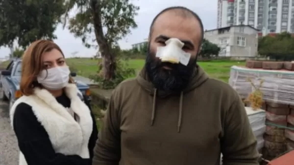 Թուրքիայում շունը կծել է ադրբեջանցի գործարարի քիթը